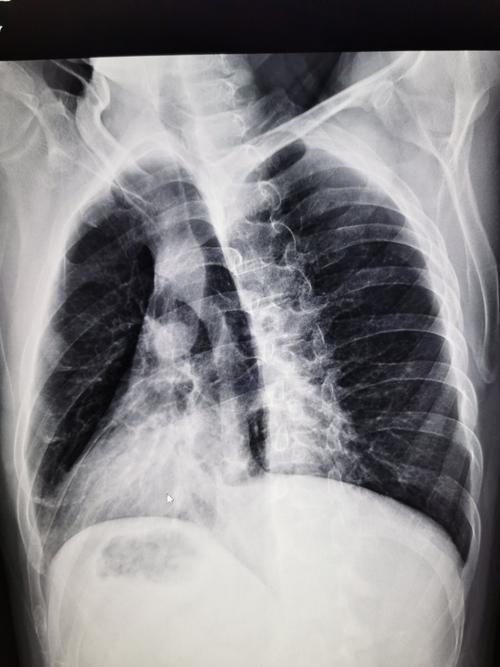 为什么肋骨骨折ct扫描一定要做三维成像