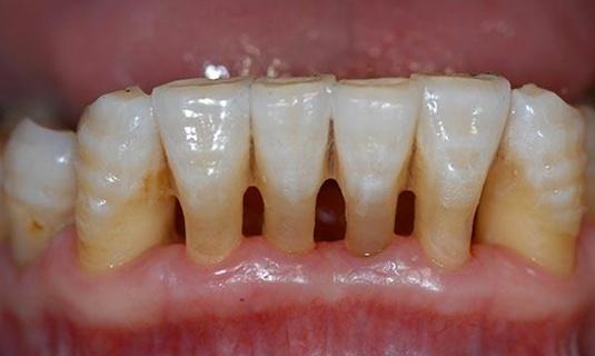 但是现在越来越多的中年人就开始出现牙齿松动,这究竟怎么回事呢?