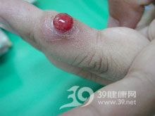 我异物肉芽肿不知道应该要怎么治疗好?