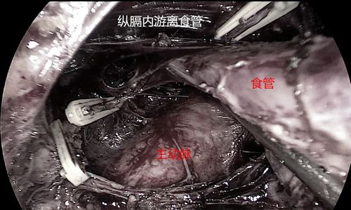 特殊病例:复发贲门癌的全腹腔镜下根治术