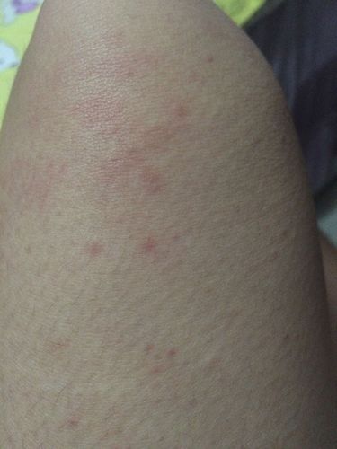 喝了点酒起了这 算是酒精过敏吗 喝了两瓶rio 四罐青岛啤酒