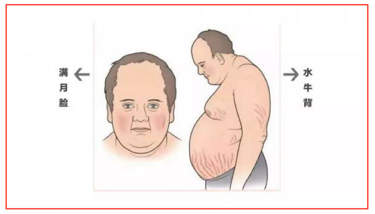 什么是库欣综合征有那些临床表现