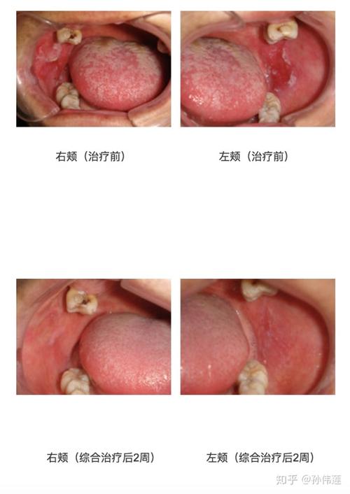 关注口腔黏膜扁平苔藓及治疗病例