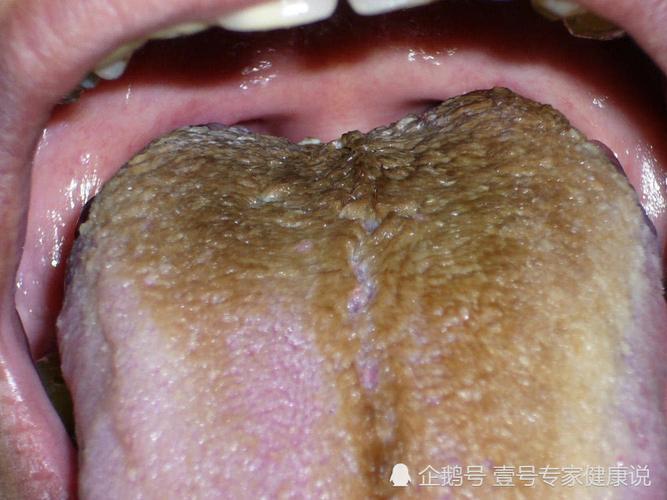 舌苔发白,发黄,发黑,分别代表什么问题?不懂中医的