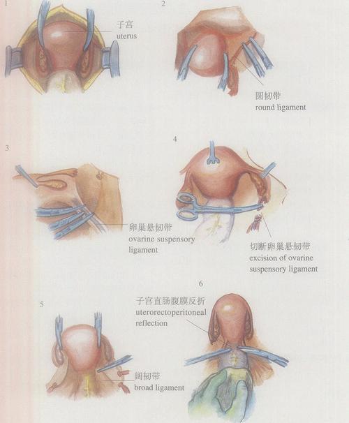 (图) 次广泛子宫切除术