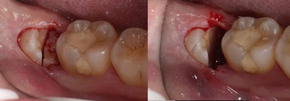 横着长的智齿是怎么拔除的?图看全过程