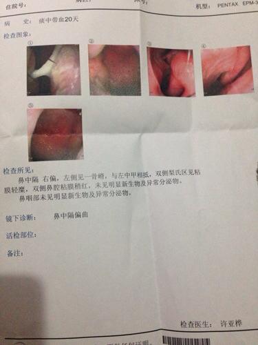 问:大概有一个月都一直发现倒吸鼻子里有血丝,时有时无的.