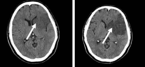 掌握5个征象,ct也能诊断超早期脑梗死