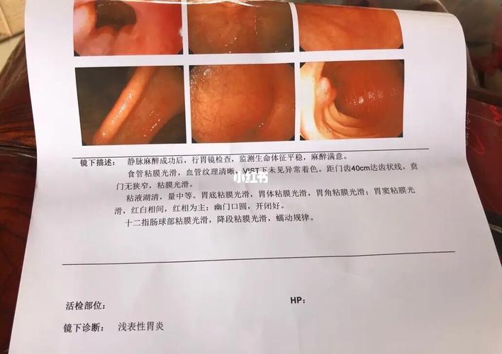 浅表性胃炎_胃炎_医疗健康_医疗健康其他