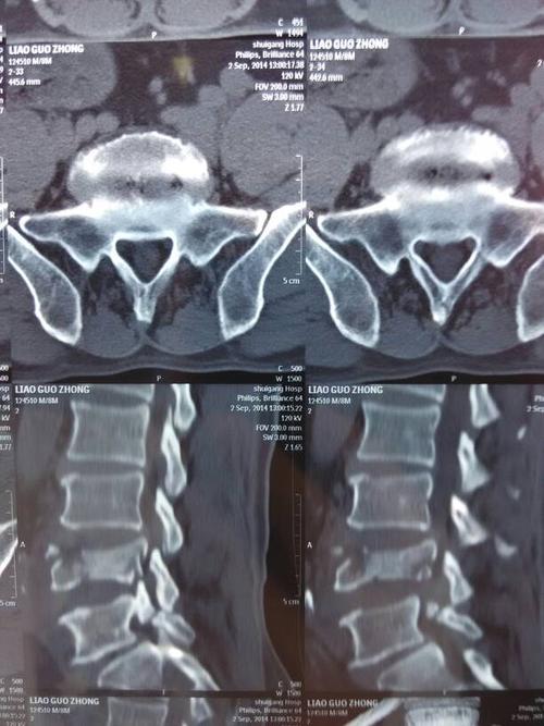 今天亲戚从高处掉下,ct后诊断为l4锥骨爆裂性骨折,大小便正常,医生说
