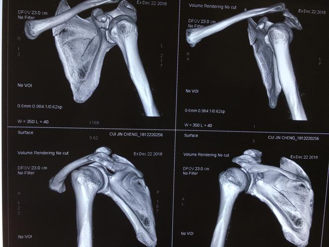 一例肩胛盂骨折肩关节镜下骨折内固定术