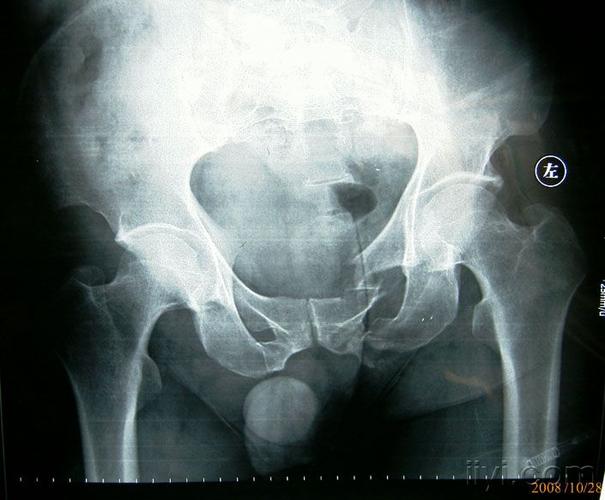 30 13:23:10坐骨支骨折  某男,48岁,因翻车砸伤骨盆,致左侧坐骨支骨折