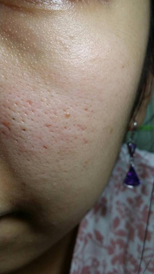 医院 脸成这样,坑坑洼洼还有很多黑点怎么治?黑点是黑头吗?