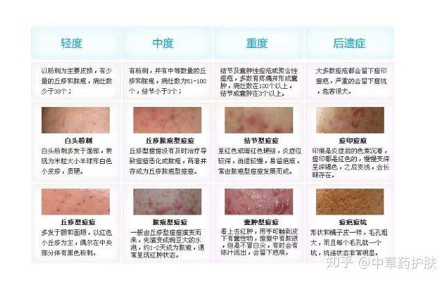 3分钟教您了解痘痘肌类型