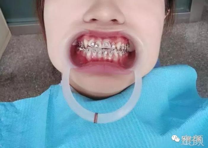 左一的门牙是死髓牙,所以颜色有点黑