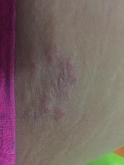 大腿内侧很痒,越抓越爽,抓完起一粒一粒的,红痛,这是咋回事,好了