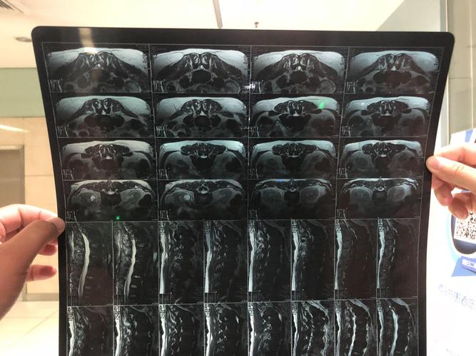 帮忙看一下核磁共振腰椎的片子!