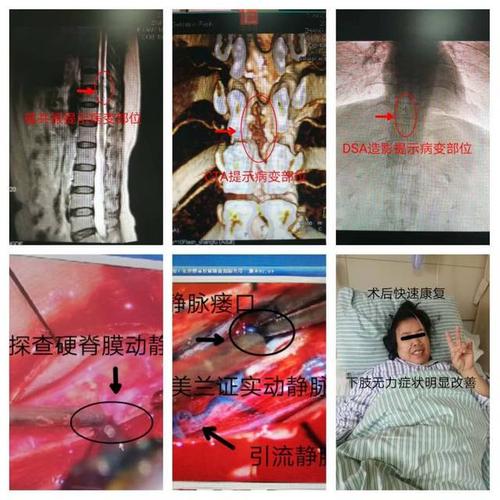 很多人没听说过脊髓硬脊膜动静脉瘘这个毛病,临床相对少见,疾病名字又