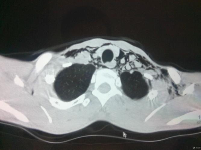 病例41:纵膈气肿(胸片 ct)
