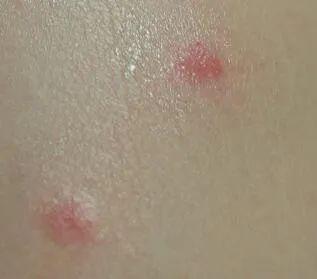 牛皮癣初期症状及图片