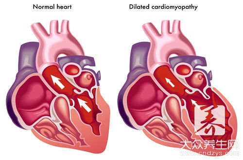 心脏房室间隔缺损