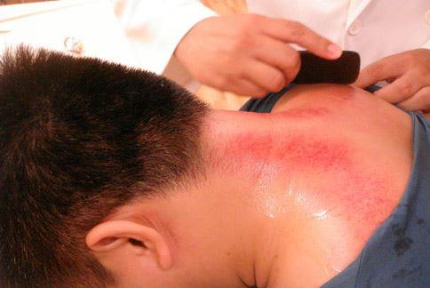中暑刮痧太用力 恐皮肤发炎感染