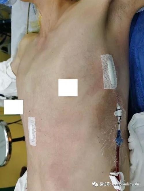 重度漏斗胸女孩wang手术成功