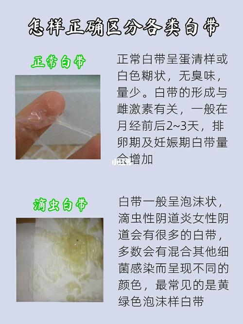 难以忍受的滴虫被我一个疗程解决了!