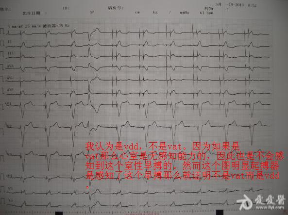 帮忙看看起搏器心电图 起搏器诊断   如 3楼wyl123123老师所言  双腔
