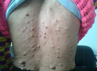 二,脂肪瘤有什么症状