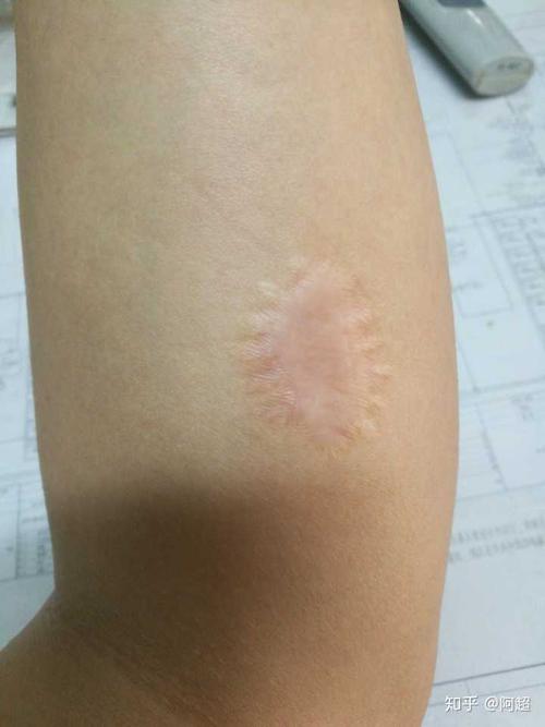 植皮手术,剪的一块皮,缝合后的样子,考虑要不要文身,来个三叶虫那种