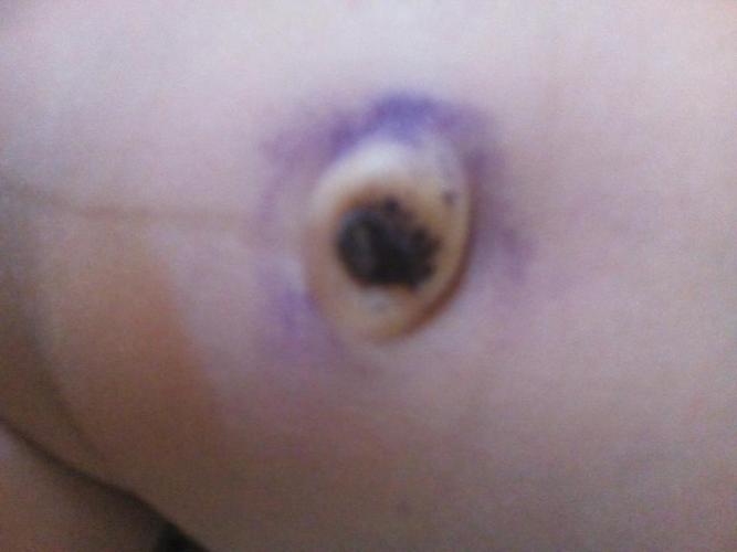 宝宝10天的时候肚脐碰掉了,现在满月了,还没长好,如图