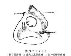 乳突根治术后外耳道重建和鼓室成形术