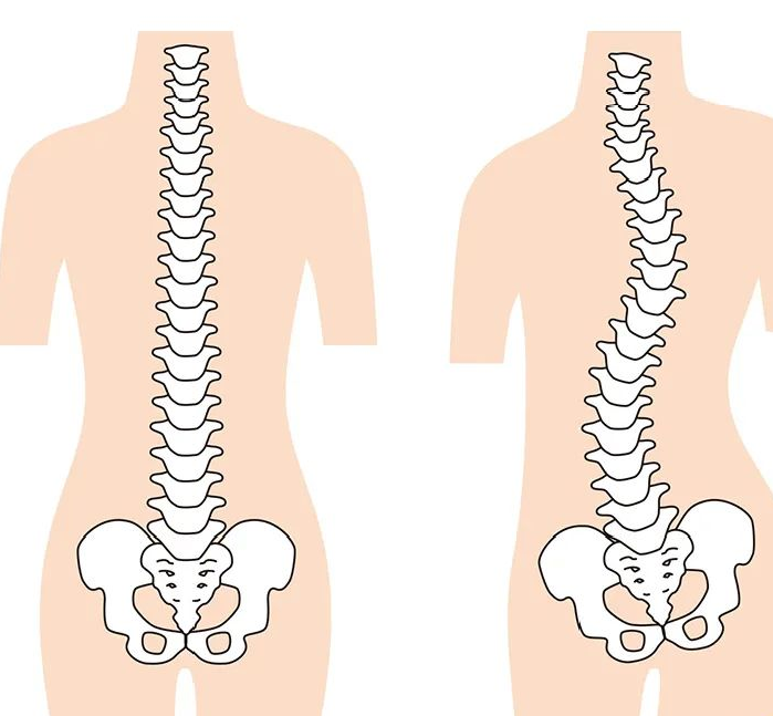 习惯性跷起二郎腿导致脊椎变形