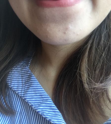 下巴的闭口怎么办啊