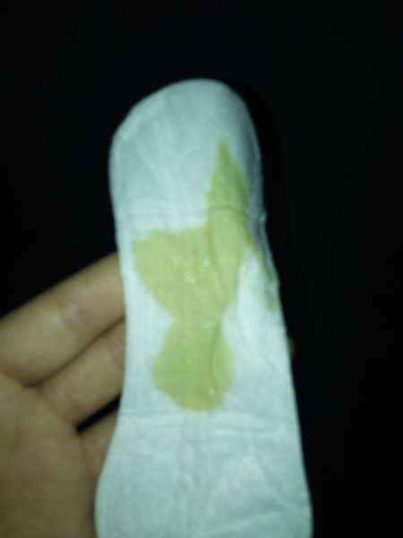 最近下体老是流黄绿色的分泌物每天都流很多是怎么回事