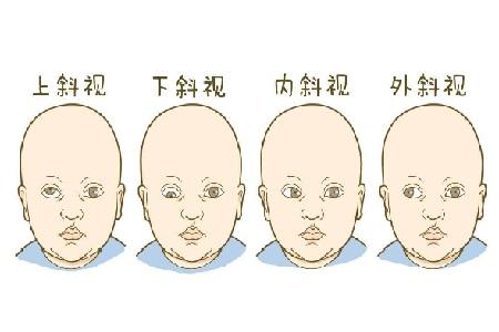 首大熊瑛儿童斜视常见的表现有哪些