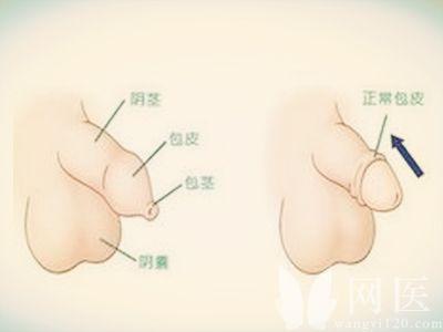 小孩包茎的危害 小儿包茎有哪些危害及防护措施