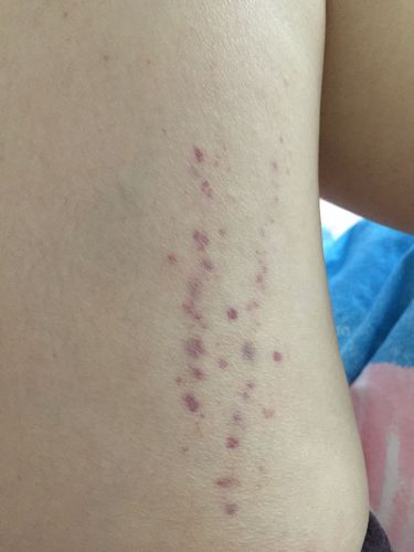 今天洗澡完后突然在两大腿内侧发现了一片紫色小斑点样的东西,不痛