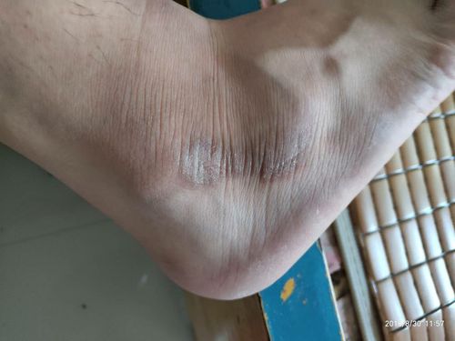 脚的这个部位皮肤发黑发硬