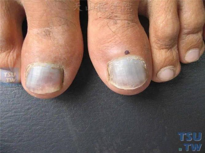 指甲变形竟然是癌关于指甲的这些暗示你知道吗