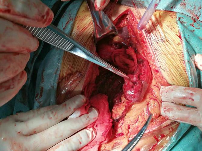 2017年首例胰十二指肠切除术