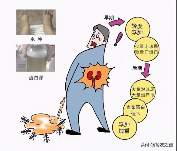 糖尿病肾病与六味地黄丸快速来了解