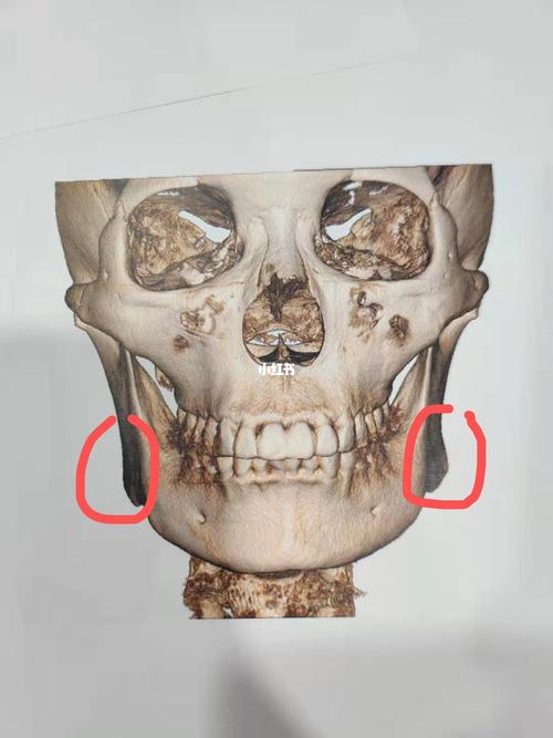 颧骨颧弓下颌角考虑,但是这个外板要做吗?_颧骨颧弓