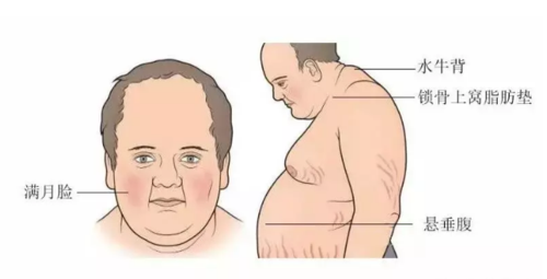 no091什么是向心性肥胖