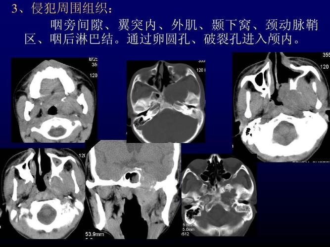 鼻咽癌的影像学诊断ppt