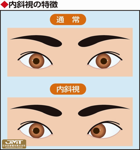 jmt 日本医疗-小儿急性内斜视,与长时间使用手机有关!