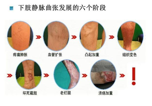 静脉曲张是由哪些原因导致的