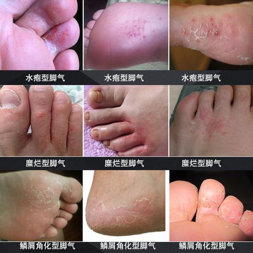 脚气膏去脚痒喷剂