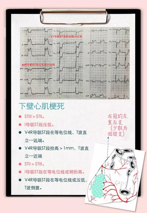 冠脉供血不足心电图图示总结